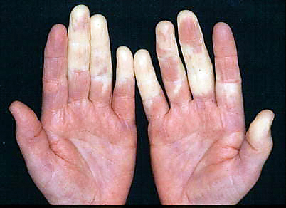 Weiße Finger deuten auf eine Durchblutungsstörung hin.
